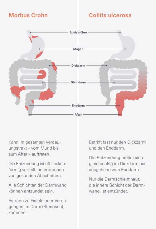 abbvie care: Entzündung im Darm